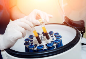 Platelet-Rich Plasma by Beauty At First Sight Med Spa in Chicago Illinois