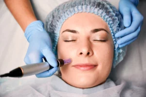 how-long-does-It-take-to-see-effects-of-candela-exceed-microneedling